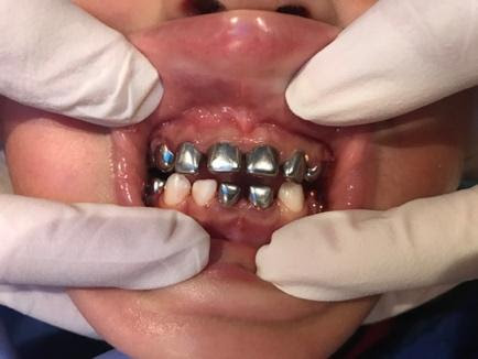 A child with Zirconia dental crowns on all 20 of the child's teeth