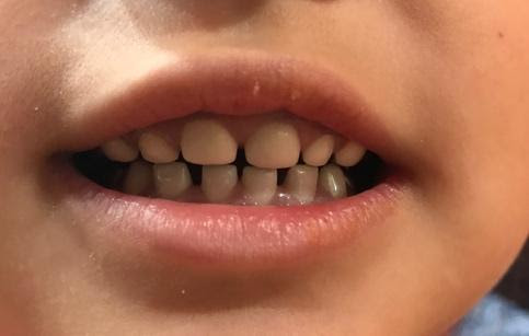 A child smiling with a mouth of zirconia dental white crowns 